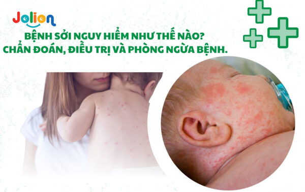 Bệnh sởi gây nguy hiểm như thế nào đối với trẻ em hình 2